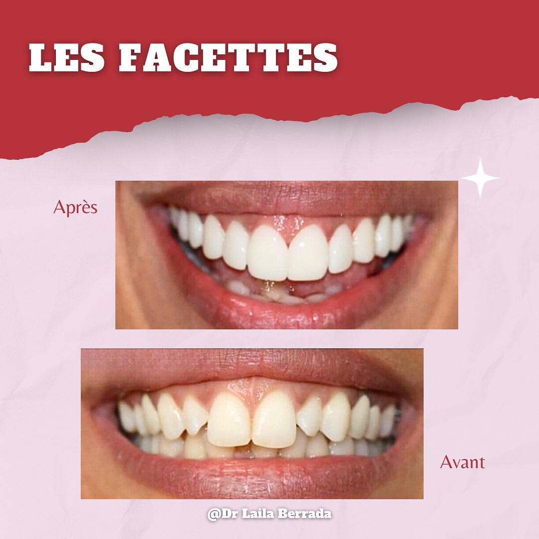 Transformation de sourire - Cas 4